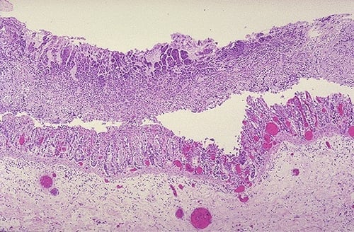 Pseudomembranous-Colitis-EHR-Optimization-Beaker